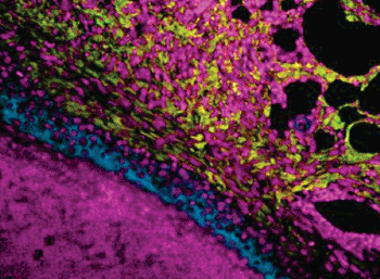 Image: Micrograph of S. aureus Skin Abscess. Cell nuclei are stained magenta and polyamine producing macrophages are blue. The host is attempting to wall off the infection by laying down a surrounding layer of collagen (gold) and other matrix proteins (Photo courtesy of Richardson Lab, University of North Carolina). 